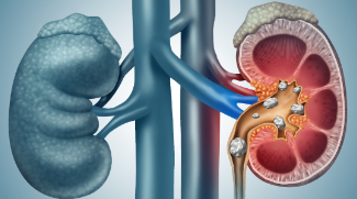 Understanding Kidney Stones: Causes, Symptoms, Treatments