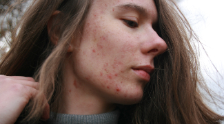 Acne: Causes, Treatment, Remedies