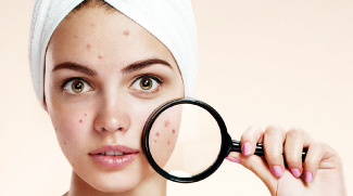 Your Ultimate Guide To Acne
