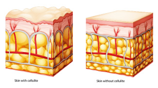 Cellulite Explained And How To Manage It