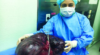 Dubai woman has 17.5kg tumour removed