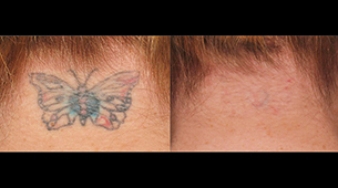 Get Rid Of Your Unwanted Tattoo